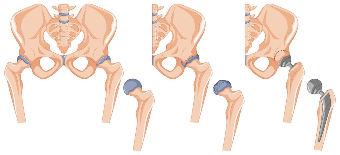 Quadril tratamento