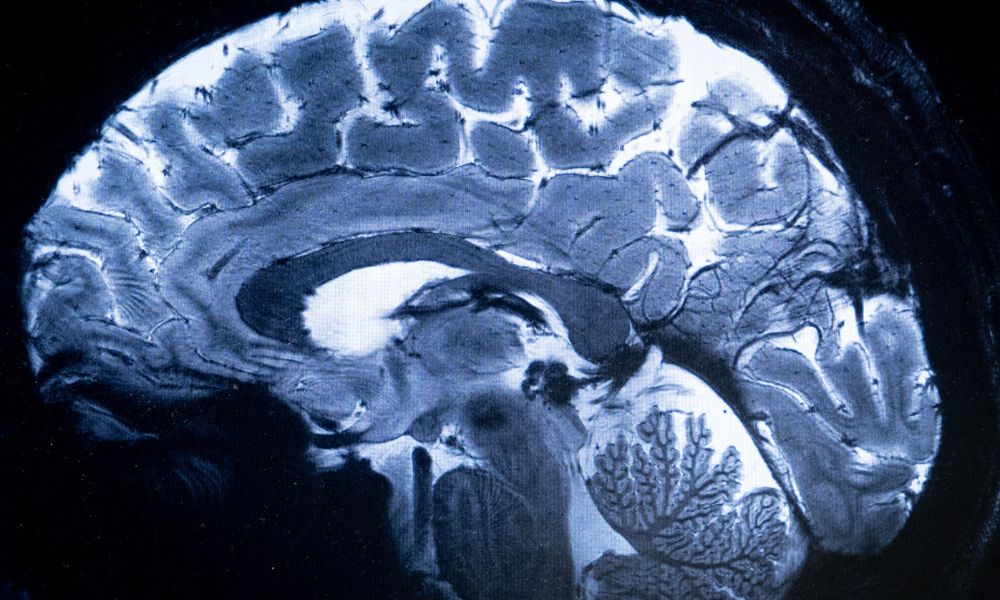 cerebro