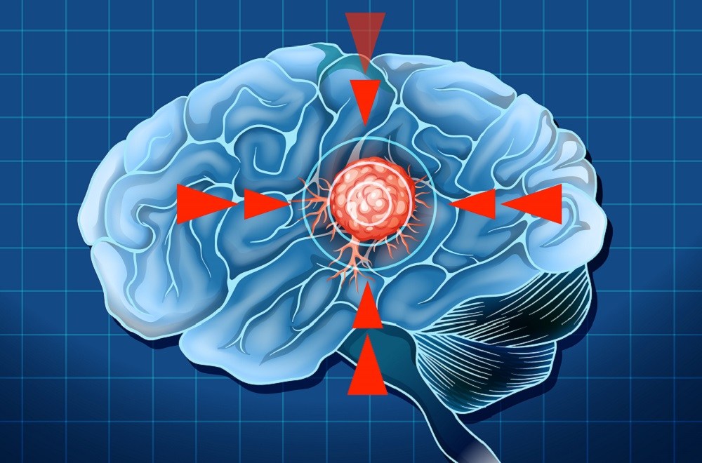 Glioblastoma: o tumor cerebral mais agressivo e o desafio da medicina moderna