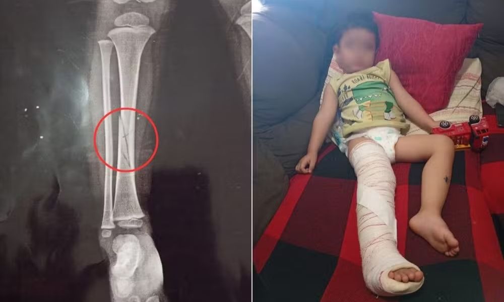 menino fratura tíbia em escola em peruibe
