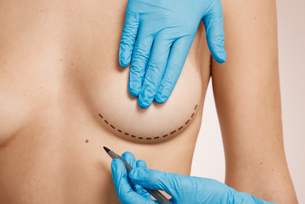 Mastopexia multiplanos com cicatriz em L melhora resultados e reduz cicatriz