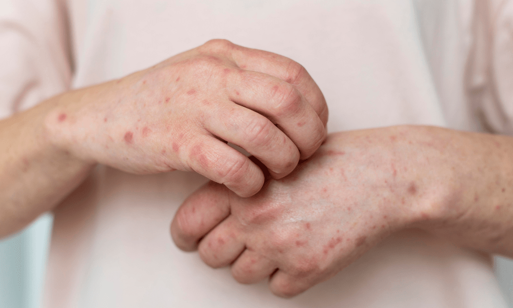 Sintomas e causas da dermatite atópica nos dias de frio