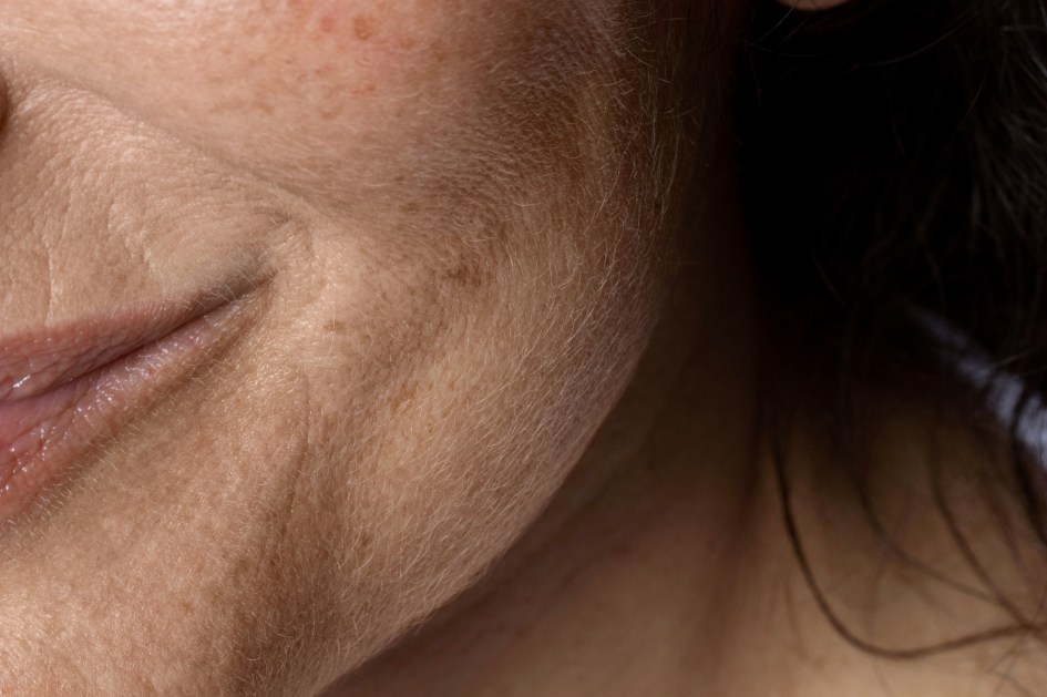 Mulher com melasma