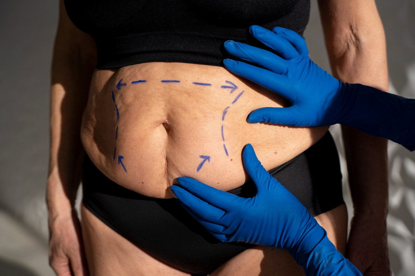 Lipoaspiração é segura? Entenda quais fatores realmente determinam o risco da cirurgia